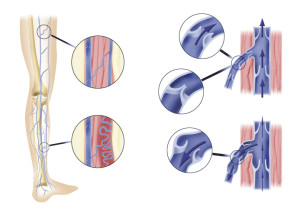 New Treatments for Peripheral Arterial Disease | Beth Israel Deaconess - WCVB Home - Health Council New Treatments for Peripheral Arterial Disease | Beth Israel Deaconess - WCVB Home - Health Council