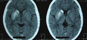 Diabetic Striatopathy in Childhood: A Case Report | Case Reports | Pediatrics - Health Council Diabetic Striatopathy in Childhood: A Case Report | Case Reports | Pediatrics - Health Council