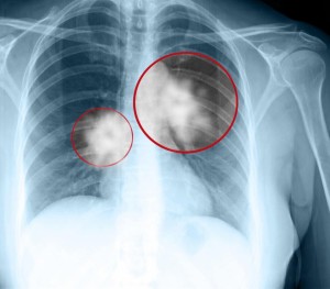 US may gain lung disease vaccine through improved relations with Cuba | Athensnews | redandblack.com - Health Council US may gain lung disease vaccine through improved relations with Cuba | Athensnews | redandblack.com - Health Council