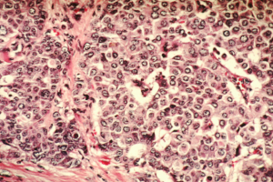 Double Mastectomy Procedures Have Tripled In Past Decade, Study Says : Health : Headlines & Global News - Health Council Double Mastectomy Procedures Have Tripled In Past Decade, Study Says : Health : Headlines & Global News - Health Council