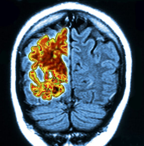 Dementia breakthrough? Scientists identify one cause sparking hope for new treatments | Health | Life & Style | Daily Express - Health Council Dementia breakthrough? Scientists identify one cause sparking hope for new treatments | Health | Life & Style | Daily Express - Health Council