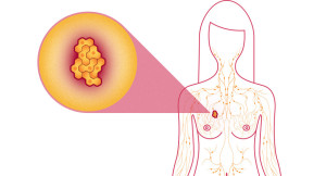 New breast cancer treatment wipes out tumours in just 11 DAYS | Daily Mail Online - Health Council New breast cancer treatment wipes out tumours in just 11 DAYS | Daily Mail Online - Health Council