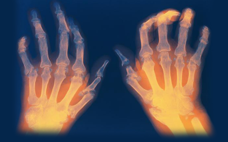 High Hopes for Individuals with Rheumatoid Arthritis - Health Council High Hopes for Individuals with Rheumatoid Arthritis - Health Council