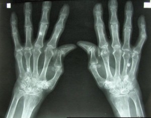 arthritis Breakthrough Technology For Bone Repair - Health Council