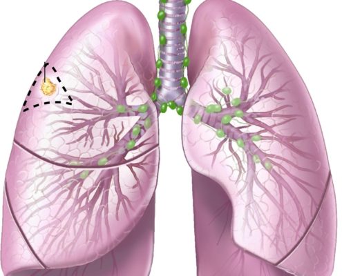 Lung Cancer Mutation Responsive Discovery - Health Council Lung Cancer Mutation Responsive Discovery - Health Council