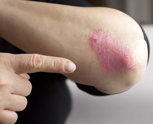 "Psoriasis and Obesity May Share Genetic Source" - Health Council "Psoriasis and Obesity May Share Genetic Source" - Health Council