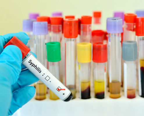 State Health Officials Of Indiana Warn Residents About Rise in Syphilis - Health Council State Health Officials Of Indiana Warn Residents About Rise in Syphilis - Health Council