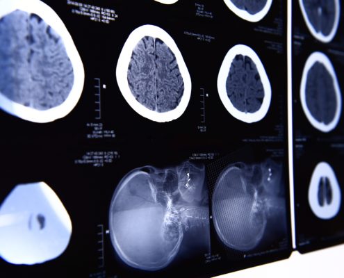 Using Proteomic Mass Spectrometry Imaging to Detect Malignant Melanoma - Health Council Using Proteomic Mass Spectrometry Imaging to Detect Malignant Melanoma - Health Council