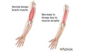 New drug to treat muscle wasting disease inclusion body myositis (IBM) reverses key symptoms - Health Council New drug to treat muscle wasting disease inclusion body myositis (IBM) reverses key symptoms - Health Council