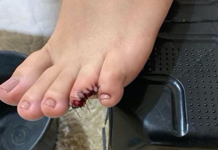 Mulher fica sem o dedo do pé após ataque de piranhas em praia do Pará