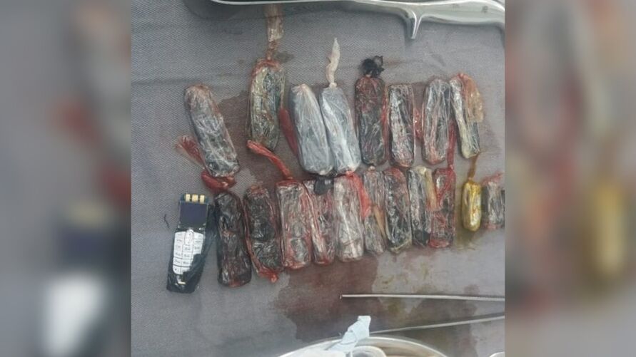 Presos passam por cirurgia para retirar escondidos do estômago