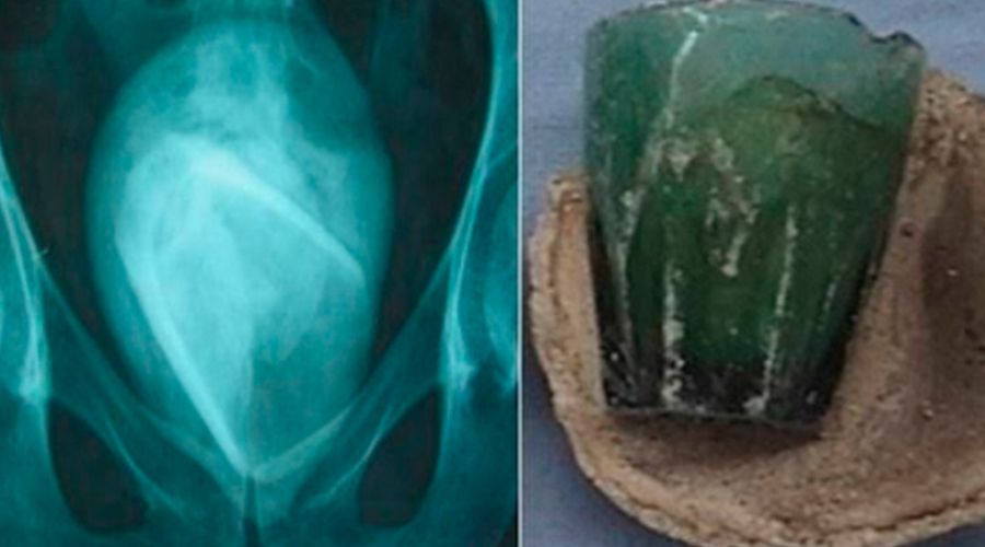 Copo de vidro é encontrado em bexiga de mulher
