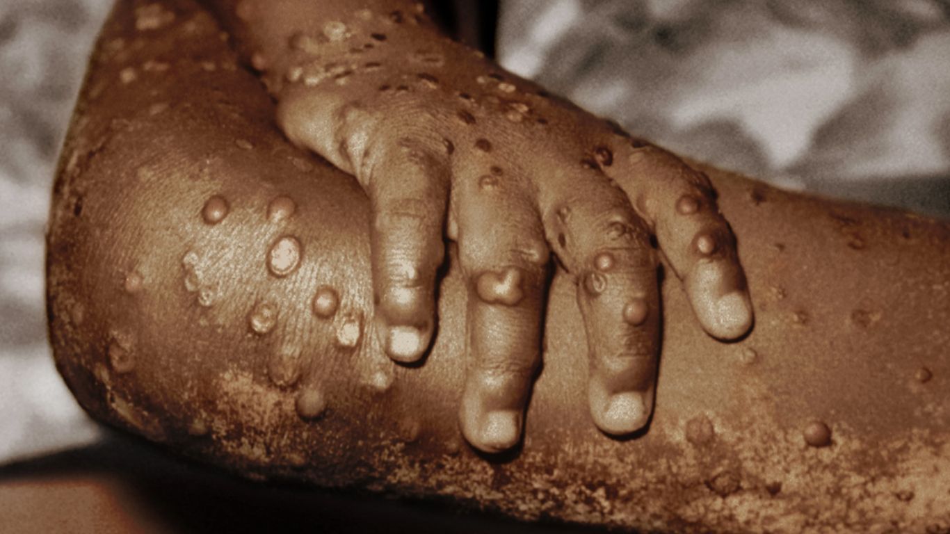 Em alerta, Amazonas observa com atenção aumento de casos de varíola dos macacos