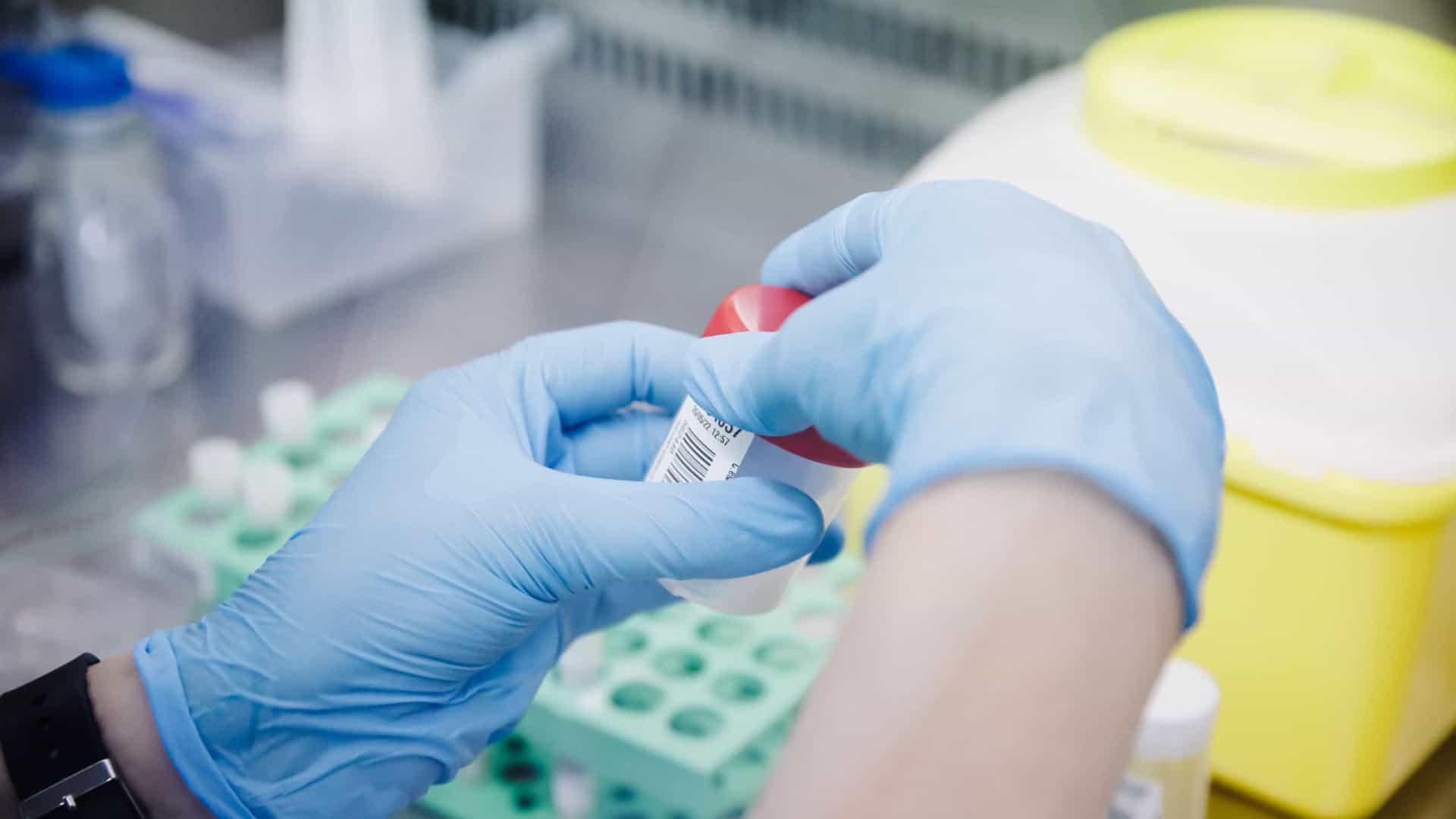 AM descarta 2 casos suspeitos de varíola dos macacos; um paciente é monitorado