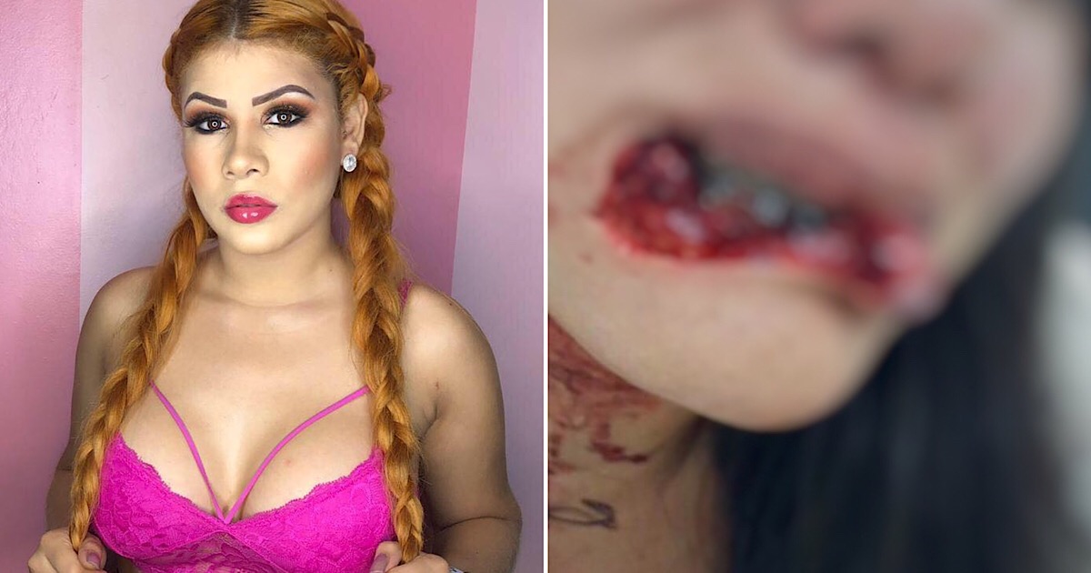 Mulher que teve os lábios arrancados em briga passará por nova cirurgia