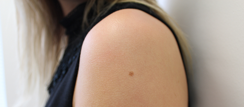 Mole in Arm