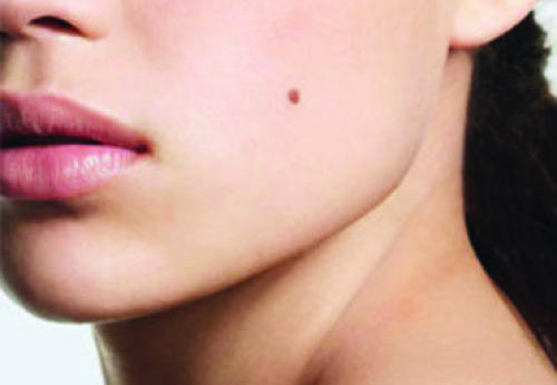 Mole in Cheeks