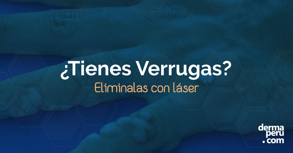 ¿Verrugas? Uso de Láser para Verrugas