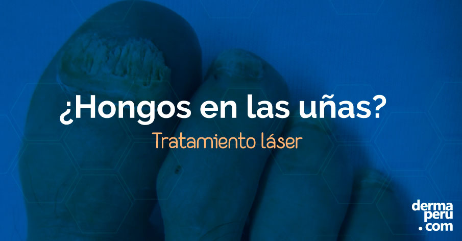 ¿Hongos en las uñas? Tratamiento a Láser