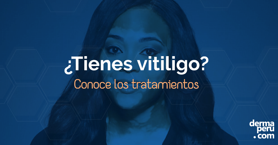 VITILIGO: ¿Qué es? ¿A quién afecta? ¿Cómo se trata?