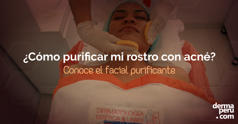Limpieza Facial Purificante: Especial para piel con acné