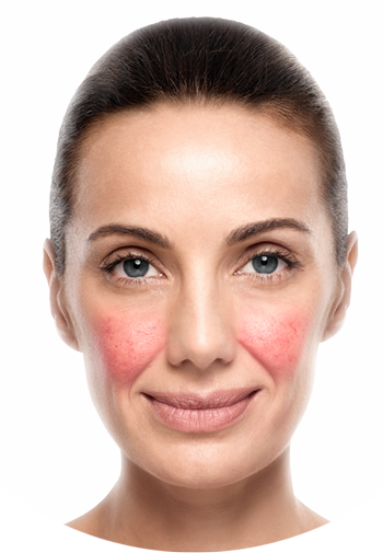 caso-de-rosacea-dermaperu-tratamiento-lima caso-de-rosacea-dermaperu-tratamiento-lima