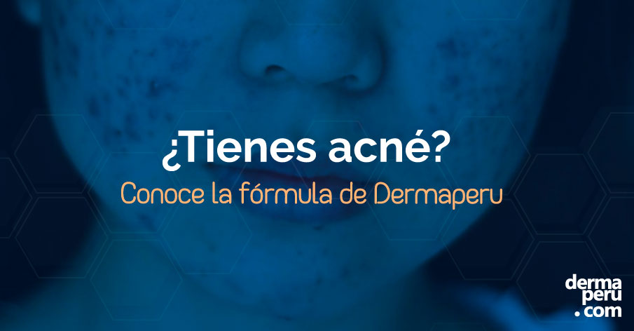 Diagnóstico especializado y obtener el mejor tratamiento de acné