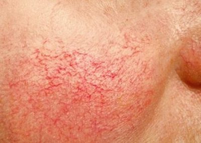 gtelangiectasia-tratamiento-dermaperu gtelangiectasia-tratamiento-dermaperu