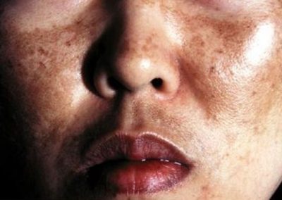 hipepigmentación-dermatologo-en-lima-tratamiento hipepigmentación-dermatologo-en-lima-tratamiento