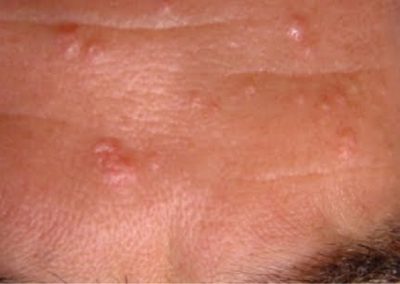 hiperplasia-sebacea-dermatoscopia-tratamiento-dermaperu-lima hiperplasia-sebacea-dermatoscopia-tratamiento-dermaperu-lima