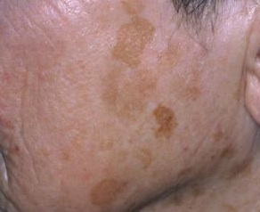lentigo-facial-tratamiento-dermaperu lentigo-facial-tratamiento-dermaperu
