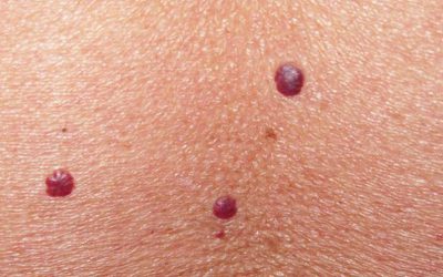 nevus-de-rubi-tratamiento-en-dermaperu nevus-de-rubi-tratamiento-en-dermaperu