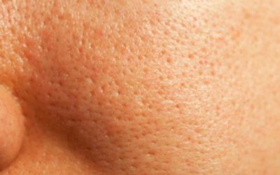 tratamiento-Poros-dilatados-en-lima-peru-dr-aparcana-dermaperu tratamiento-Poros-dilatados-en-lima-peru-dr-aparcana-dermaperu