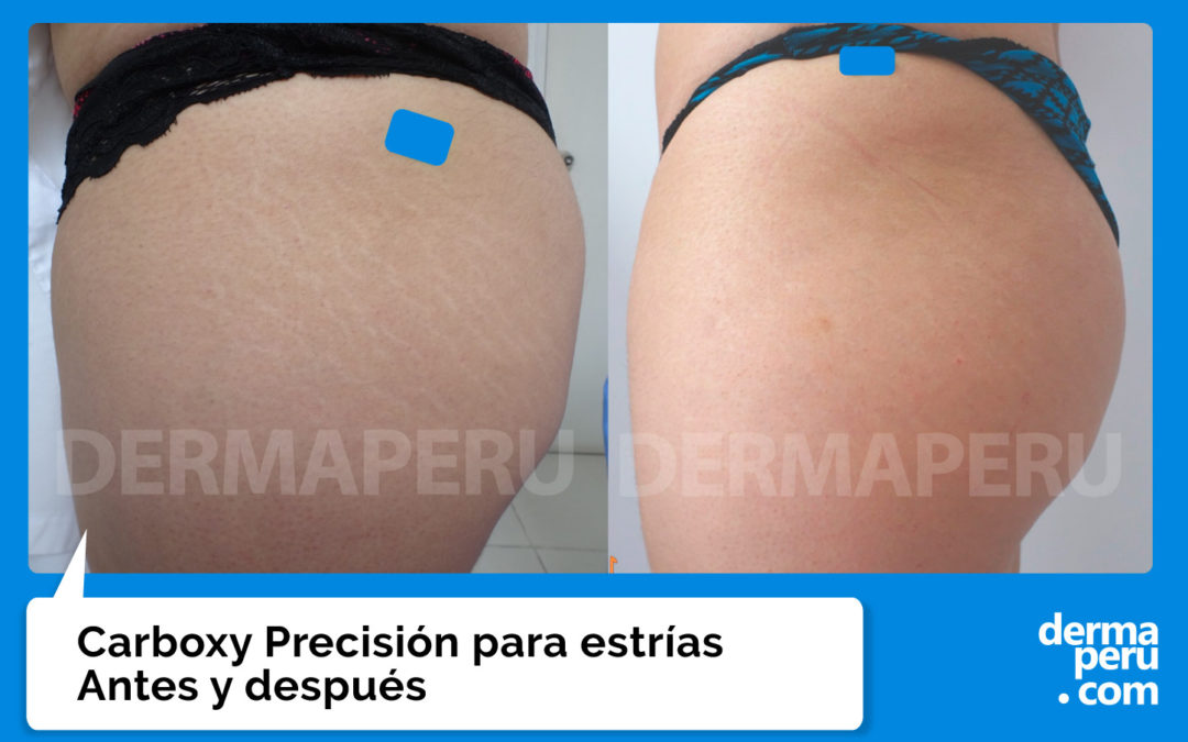 Carboxy Precisión para Estrías – Antes y Después