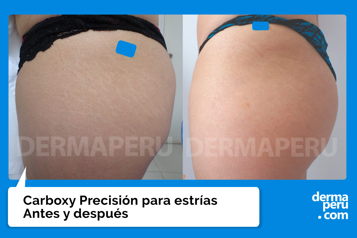 resultados-antes-y-después-de-carboxy-precision-para-estrías-en-peru-lima-por-dr-aparcana-en-dermaperu Tratamiento para estrías en muslo