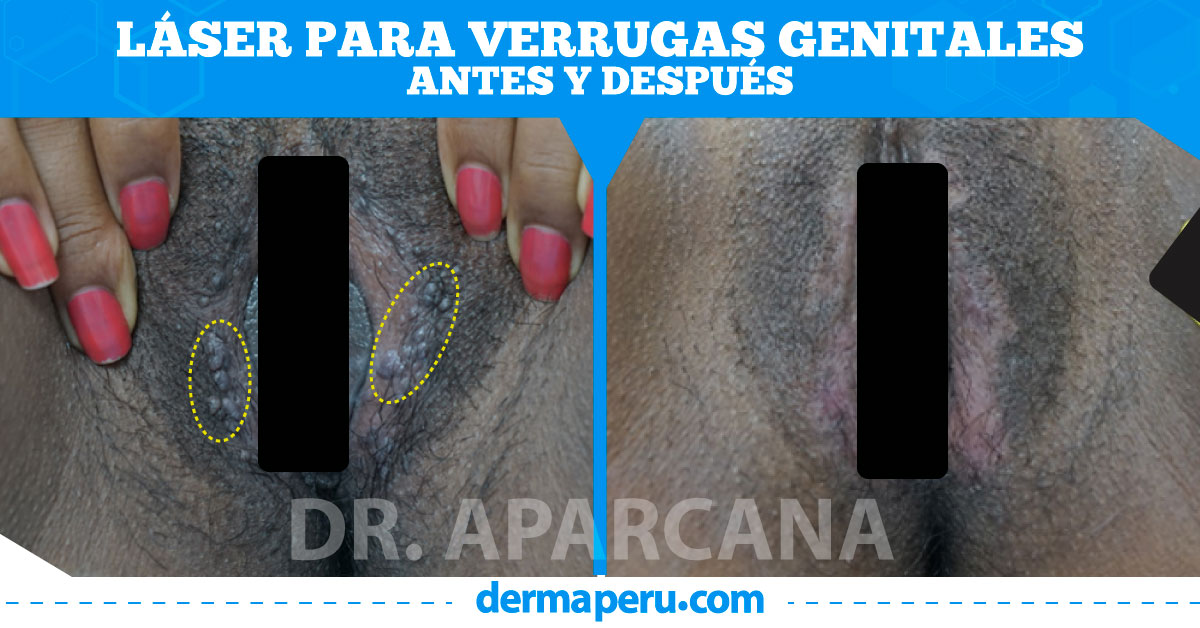 antes-y-después-de-verrugas-genitales-dermaperu-lima-peru-dr-aparcana-01.1 antes-y-después-de-verrugas-genitales-dermaperu-lima-peru-dr-aparcana-01.1